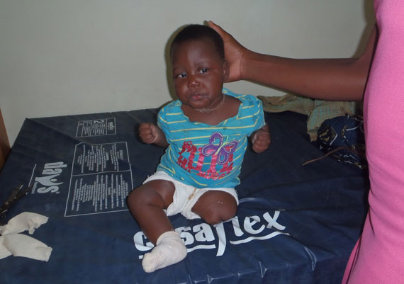 Faith Before Receiving Her Prosthesis