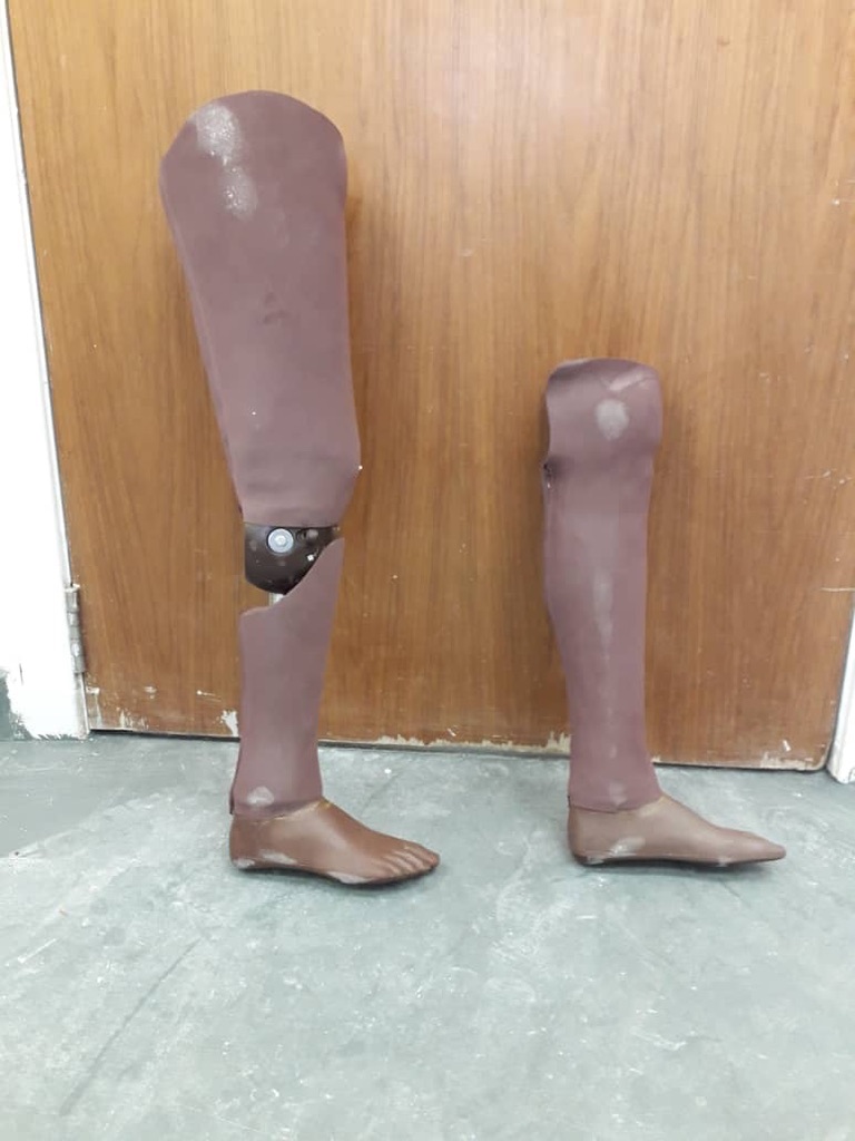 Chisomo's prosthetics